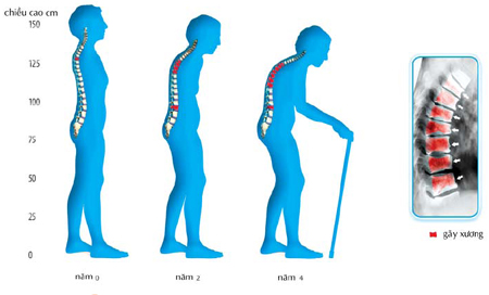 Bệnh hay gặp ở phụ nữ tuổi trung ni&ecirc;n 1