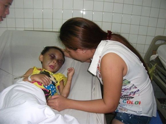 Bé Ngân đang được điều trị tại bệnh viện đa khoa Bình Dương