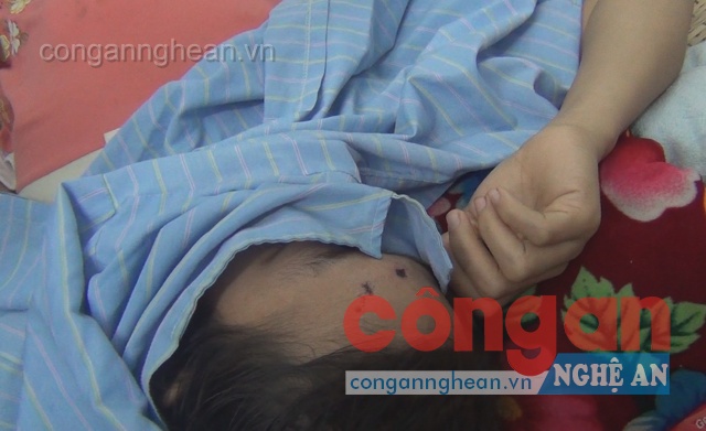 Trán nạn nhân cũng bị đạn bắn sượt qua