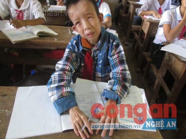 Dù bị dị tật bẩm sinh nhưng bằng nghị lực phi thường,  em đã cố gắng vượt qua nỗi đau bệnh tật