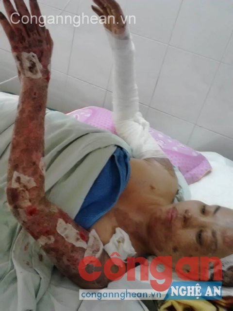 Chị Dương đang điều trị tại bệnh viện 	
