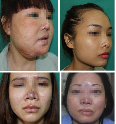 Một số tai biến sau phẫu thuật thẩm mỹ nâng ngực, làm mũi, mí, bơm căng da mặt v.v…