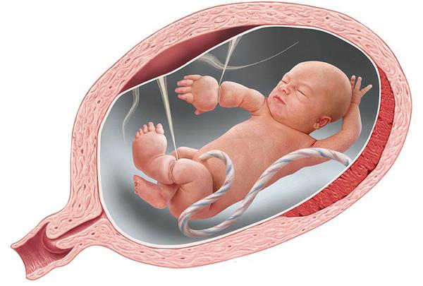 Dải sợi ối siết chặt cổ tay và chân thai nhi