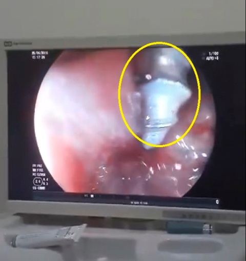 Hình ảnh dị vật quan sát qua Nội soi