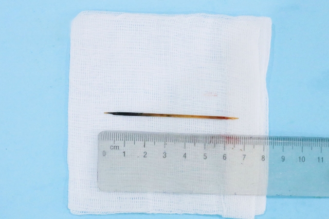 Dị vật sau khi được gắp ra, đó là chiếc tăm tre nhọn 2 đầu, chiều dài 7cm