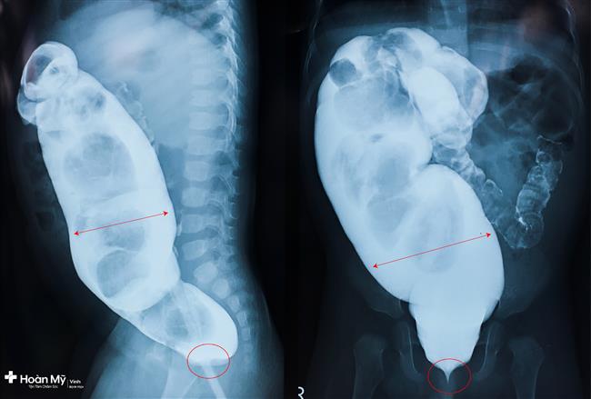 Hình ảnh chụp cộng hưởng từ (MRI) cho thấy, trực tràng và một phần đại tràng sigma giãn to do chất thải không được đẩy ra hết