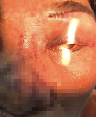 Bệnh nhân bị biến chứng mù mắt sau khi tiêm filler làm đẹp.