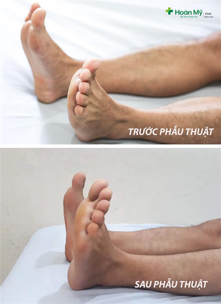 Đôi chân người bệnh trước và sau phẩu thuật khớp háng