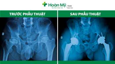 Thay khớp háng đồng thời hai bên cho nhiều người bệnh
