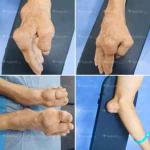 Biến dạng tứ chi vì bệnh gout