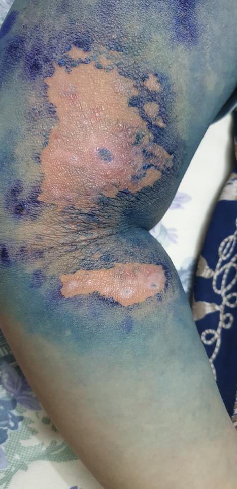 Vùng da ở cánh tay bị tổn thương do độc tố kiến ba khoang gây ra.