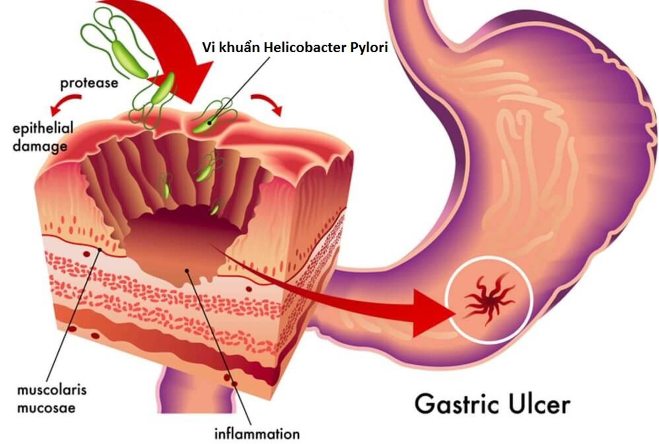 Vi khuẩn H.P (Helicobacter Pylori) đã được khoa học xác định là tác nhân gây ung thư dạ dày.