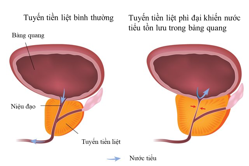 Tuyến tiền liệt phì đại gây tồn lưu nước tiểu trong bàng quang.