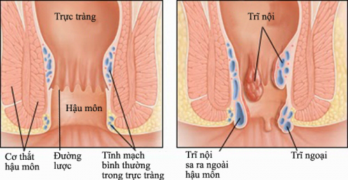 Thai phụ bị bệnh trĩ nên ngâm nước ấm vùng hậu môn 2-3 lần mỗi ngày, chăm đi bộ, uống đủ nước và tránh ăn nhiều gia vị cay như: ớt, tiêu…