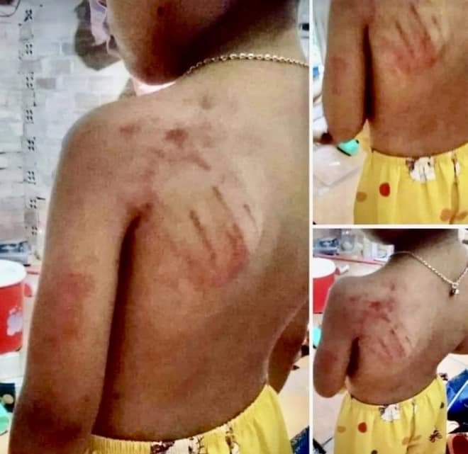 Hình ảnh vết thương bầm tím ở lưng được phụ huynh chụp lại, đăng tải lên facebook