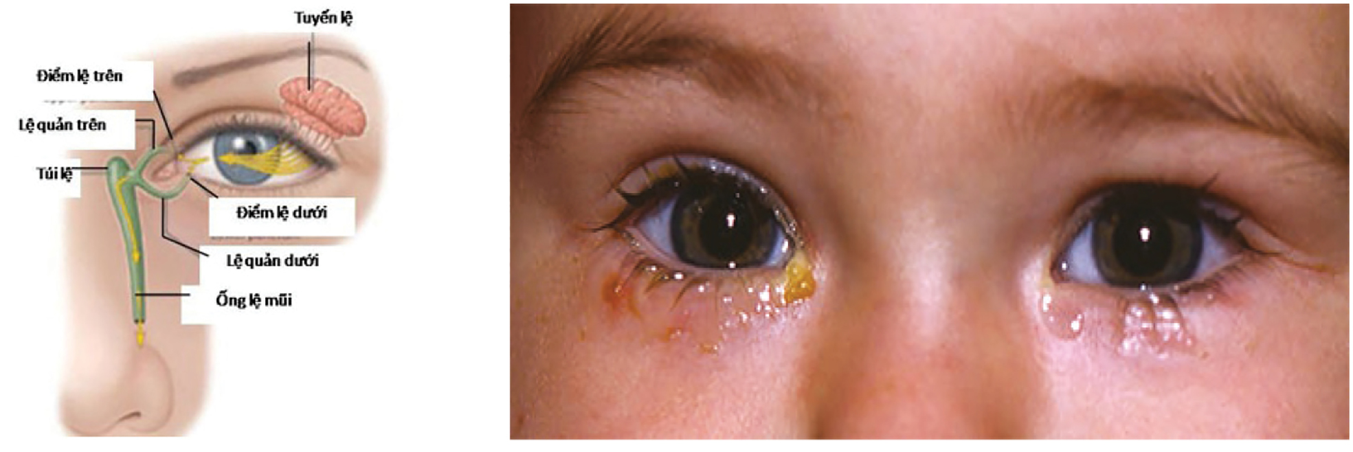 Hình ảnh ống dẫn lệ (bên trái). Tắc ống lệ mũi hai bên với hiện tượng chảy nước mắt và đóng vảy quanh mắt.