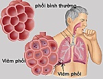 Cảnh giác với viêm phổi người lớn