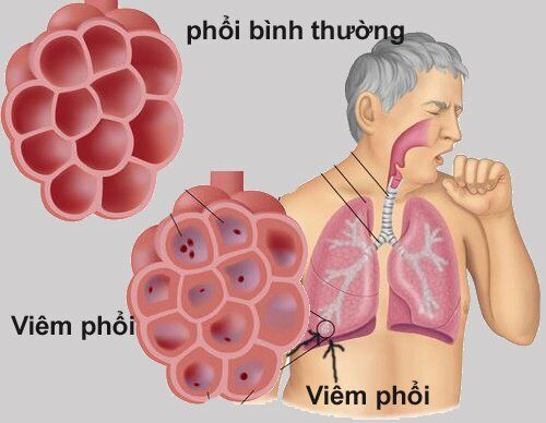 Nguyên nhân gây bệnh viêm phổi thường gặp là vi khuẩn Streptococcus pneumoniae.