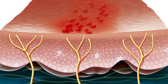 Tùy theo các dây thần kinh bị ảnh hưởng bởi virus zona, có thể gây ra nhiều hệ lụy trong đó có viêm não, viêm màng não.