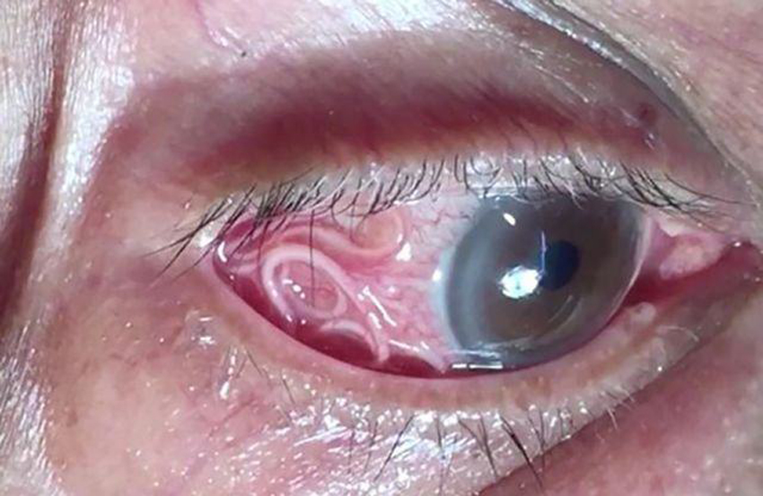 Mắt người nhiễm sán chó.