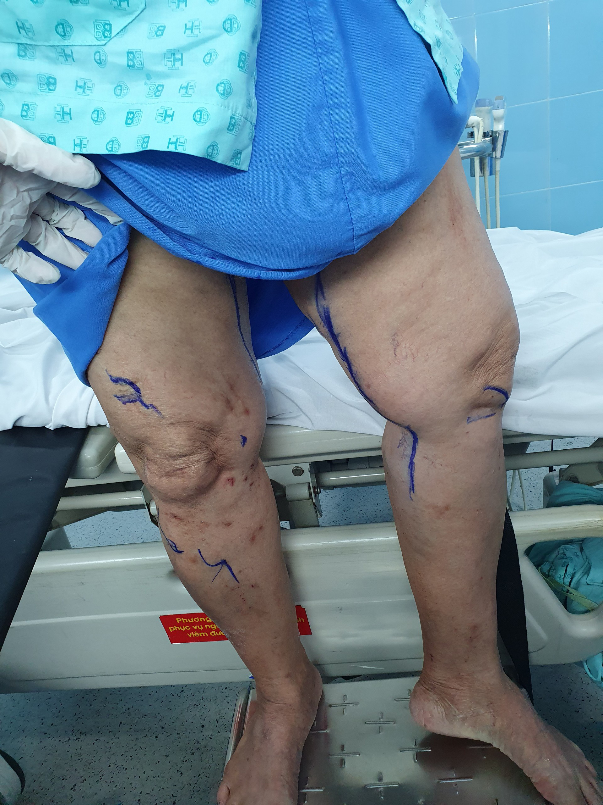 Bác sĩ đánh dấu tĩnh mạch suy trên chân bà N.