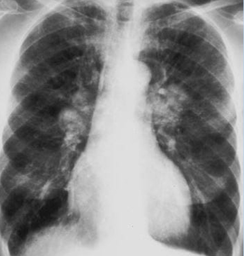 Hình X quang của bệnh nhân COPD cho thấy tổn thương ở hai bên phổi.