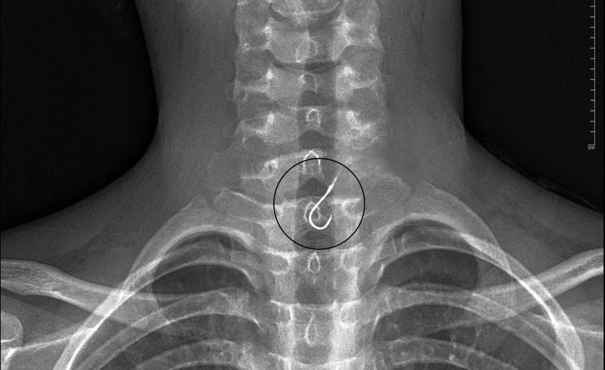 Phim X-quang cho thấy, lưỡi câu nằm trong thực quản của bệnh nhân.