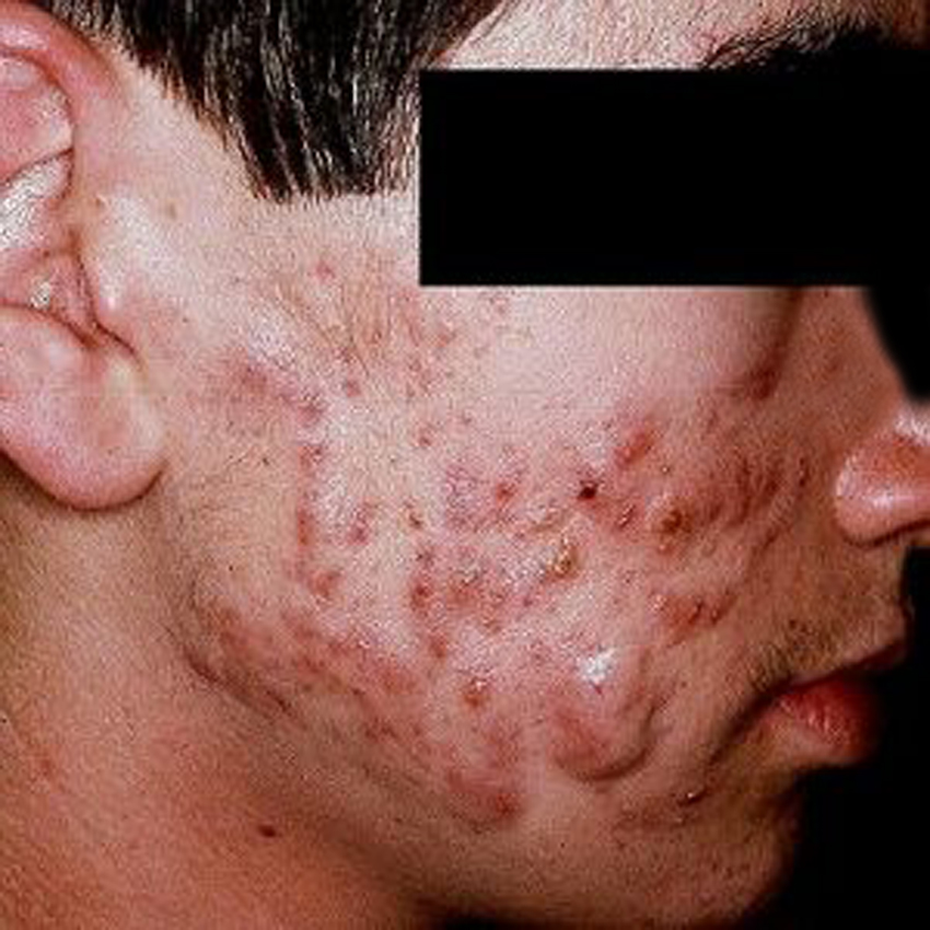 Nặn mụn trứng cá không đúng cách, không hợp vệ sinh có thể gây ra mụn bọc.
