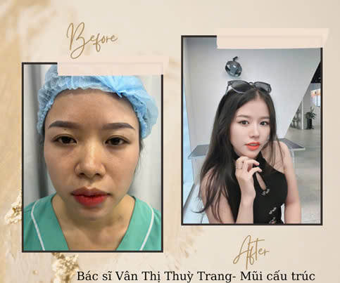 Sở hữu dáng mũi tuyệt đẹp sau khi thực hiện nâng mũi tại viral.