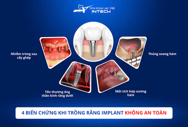 7 biến chứng cần lưu ý sau khi cắm răng implant