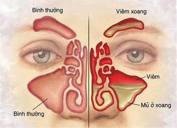 Viêm xoang cấp là tình trạng viêm nhiễm xảy ra ở các xoang mũi