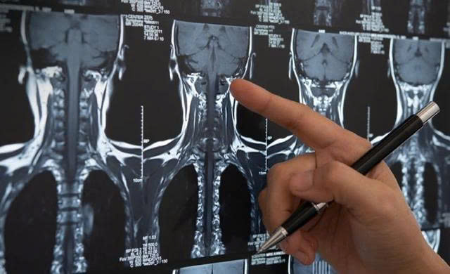 Hình ảnh chụp MRI cho thấy khối u di căn tại vùng cột sống thắt lưng.